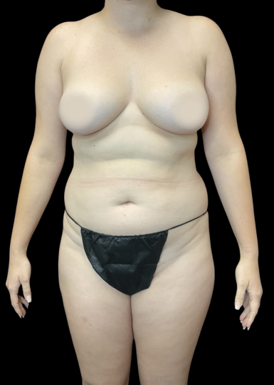 Smartlipo of the Back - Flanks, Bra Rolls, and Neck Humps - Explore Plastic  Surgery